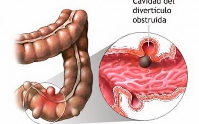Enfermedades Diverticulares