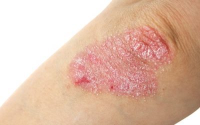 La pérdida de peso podría reducir la psoriasis